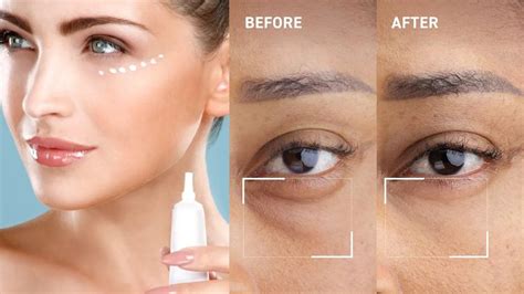 5 Best Under Eye Creams For Dark Circles For Effective Results