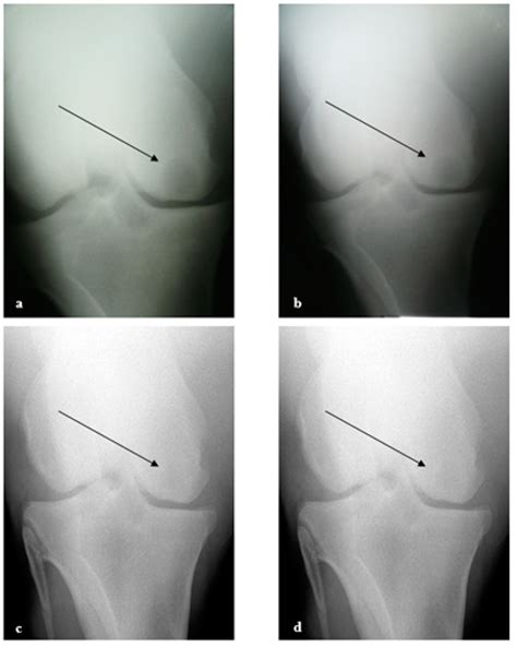 Arthroscopic Treatment of a Subchondral Bone Cyst via Stem Cells ...