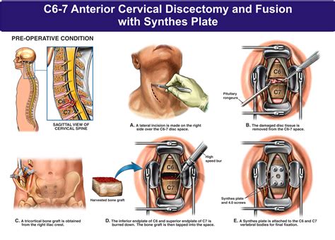 Cervical Discectomy And Fusion