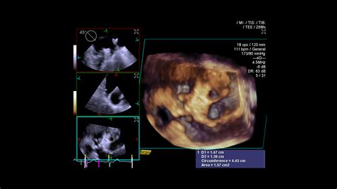 Cardiovascular Ultrasound | ACUSON SC2000 Ultrasound System - Siemens ...