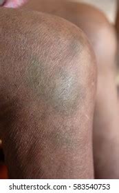 Image result for Exploding Massive Knee Abscess