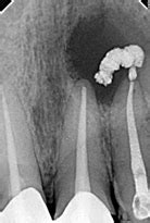Non surgical management of a large periapical cyst like lesion using ...