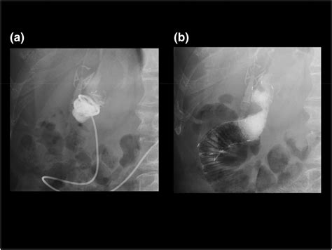 Afferent loop syndrome following pancreatic head cancer surgery treated with metal stent ...