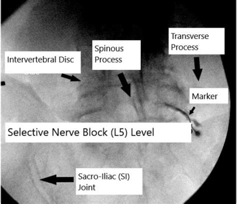 Image result for Selective Nerve Root Block Contrast Spread Pattern