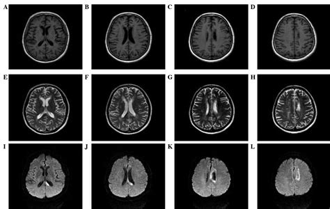 Image result for Alien Arm Syndrome