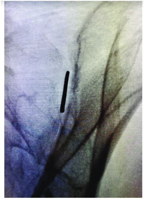 Image result for Contralateral Oblique View