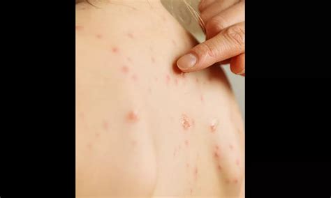 Clade 9 VZV New Chickenpox Variant: Know Symptoms, Prevention Tips
