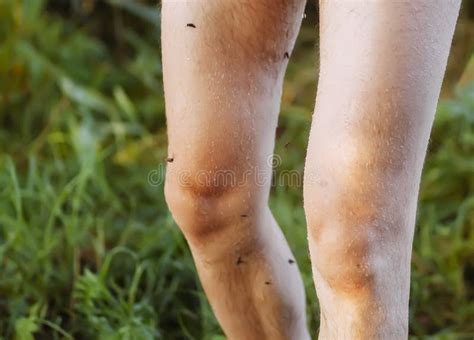 Image result for Insect Removal From Humans