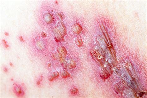 How Long Does The Herpes Zoster Virus Live On Surfaces at Steve Grange blog