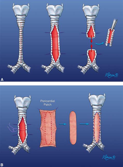 Congenital Tracheal Stenosis: Tracheal Autograft Technique - Operative Techniques in Thoracic ...
