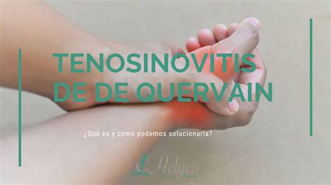 Tenosinovitis de De Quervain. ¿Qué es y cómo podemos solucionarla?