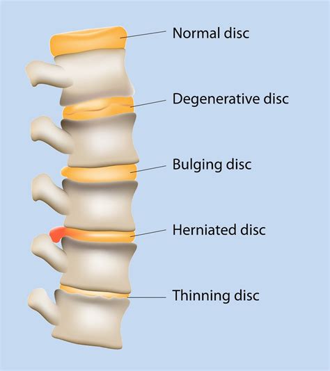 Degenerative Disc Disease Knee at Keith Joseph blog