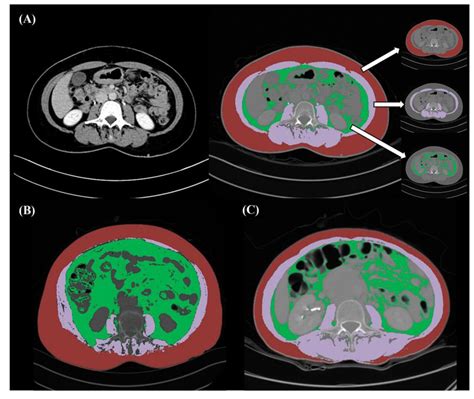Impact of CT-Determined Sarcopenia and Body Composition on Survival ...