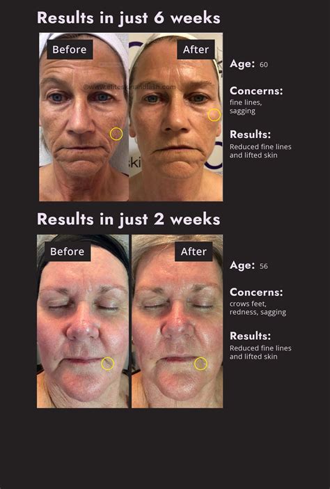 Microcurrent Facial Devices | Microcurrent Therapy | 7ewellness