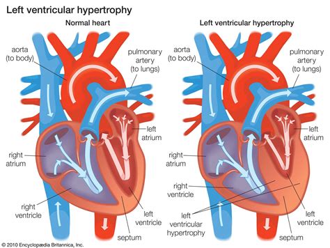 Cardiovascular disease - Ventricular Dysfunction, Heart Failure ...