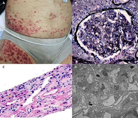 Pauci-immune proliferative glomerulonephritis and fungal endocarditis ...