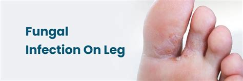 How to Treat and Prevent Fungal Infections on the Legs?