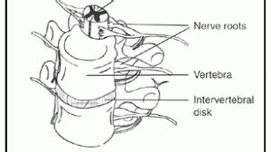 SPINAL STENOSIS – AN OVERVIEW