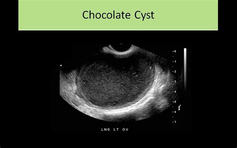 Chocolate Cyst Ultrasound
