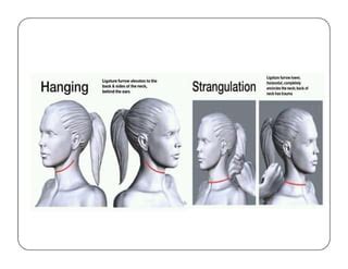 Image result for Postural Strangulation
