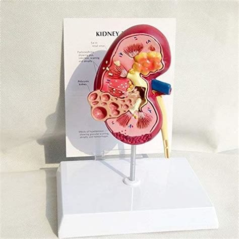 Buy ZJHCC Human Kidney with Adrenal Gland Model, Kidney w/Pathologies ...