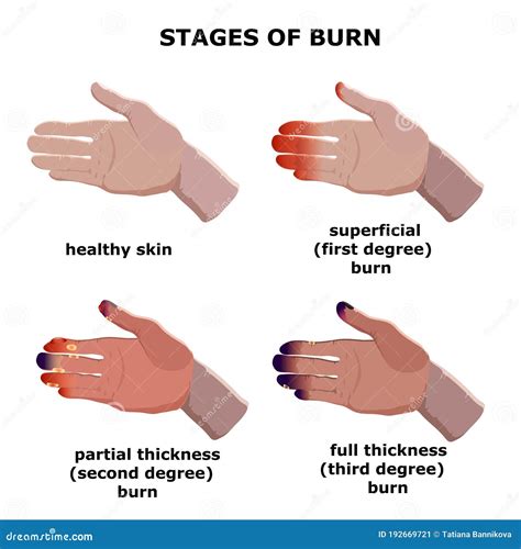 Phases Of Burn Healing