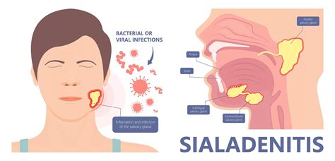 Salivary Gland Disease: Types, Symptoms, and Care