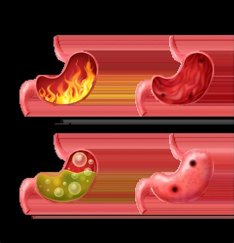 Can acid reflux disease cause asthma flare-ups? | Bangalore Gastro Centre