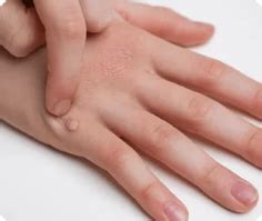 DermaClinix | Skin Concerns Wart