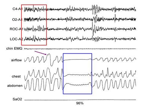 Image result for Sleep Apnea Example