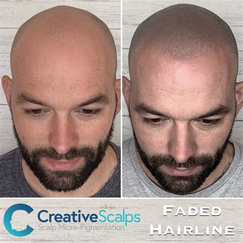 Scalp Micropigmentation before & after results | Best SMP results
