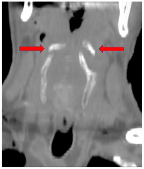 Hyoid Bone Fracture Pattern Assessment in the Forensic Field: The ...