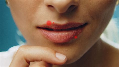Cold Sore vs Pimple: How to Prevent, Treat, and Tell the Difference Between Them | Allure