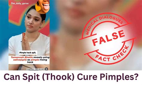Fact Check: Can Spit (Thook) Cure Pimples?