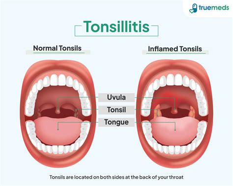 Tonsillitis: Causes, Symptoms & Treatment Options