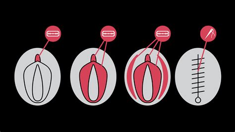 Types Of Circumcision Cuts