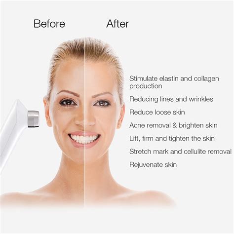 Radio Frequency Facial (RF) - Aesthetic Skin Clinic Watford