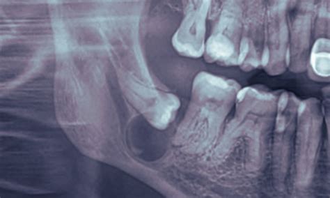 Unusual Presentation of Lateral Periodontal Cyst in Molar Region of ...