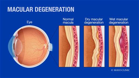 Dry Macular Degeneration