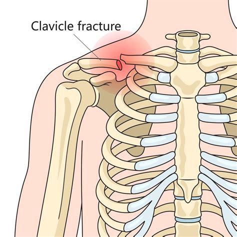 Best Clavicle Fracture Treatment | Collarbone Fracture