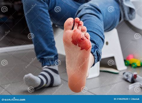 Laser Removal of Wart from the Foot. Cut Out Verruca. Immediately after Surgery. Blood Flows ...