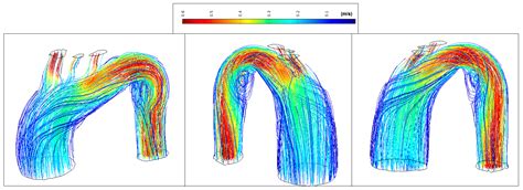 Aorta Ascending Aneurysm Analysis Using CFD Models towards Possible ...