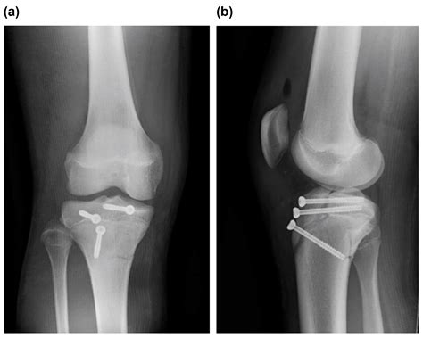 Type V Tibial Tubercle Avulsion Fracture with Suspected Complication of Anterior Cruciate ...