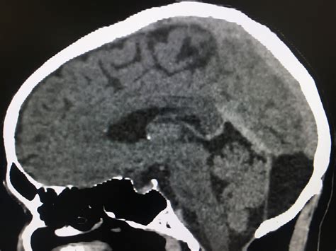 Mega Cisterna magna Vs Retrocerebellar Arachnoid cyst