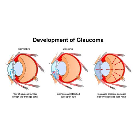 Glaucoma Treatment in Abu Dhabi | Glaucoma Laser Surgery | Samaya Hospital