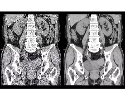 Philips - Big Bore RT Big Bore RT
