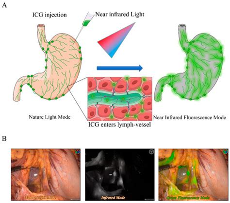 Mapping Lymph Node during Indocyanine Green Fluorescence-Imaging Guided ...
