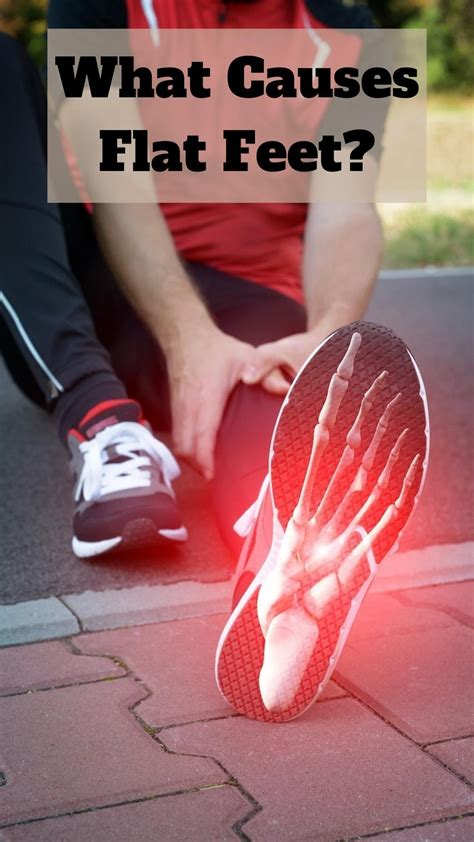What causes flat feet – Artofit