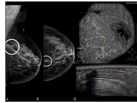 Associating Automated Breast Ultrasound (ABUS) and Digital Breast Tomosynthesis (DBT) with Full ...