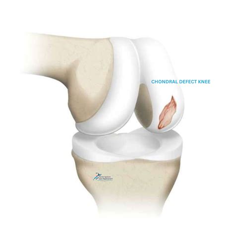 Knee Cartilage Injuries & Chondral Damage - Hip, Knee, Shoulder Surgeon Newcastle - Dr Ben McGrath